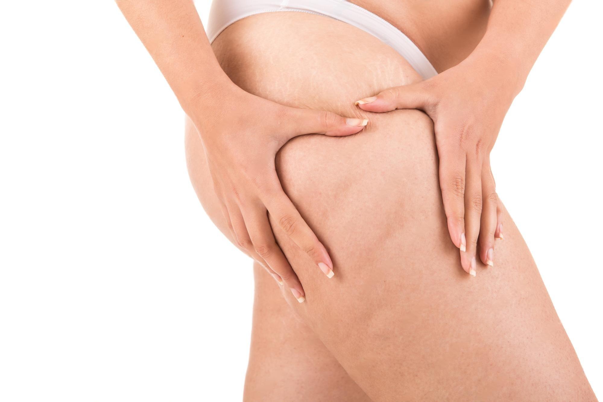 Say Goodbye to Bulky Thighs: Expert Liposuction by Dr. Divya Sai, Leading Female Plastic Surgeon in Hyderabad