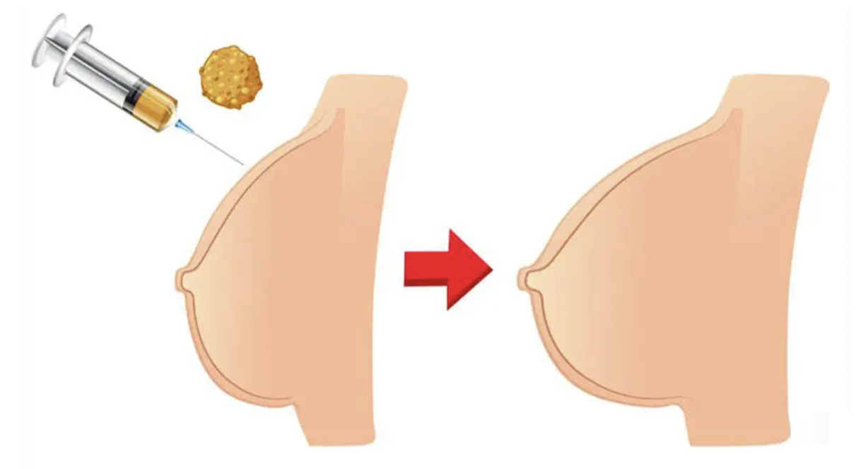 How Breast Augmentation with Fat Grafting Can Help You Sculpt Your Dream Shape Safely and Permanently