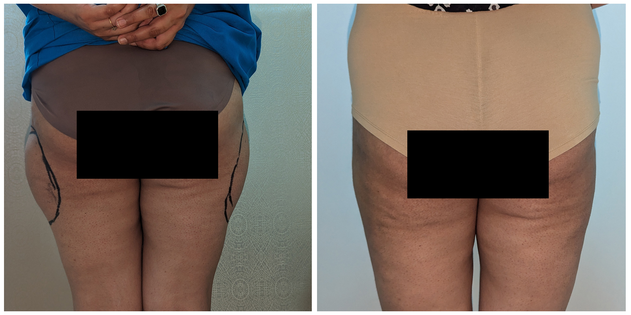 Thighplasty